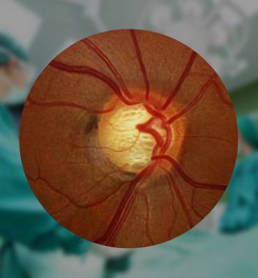Glaucoma